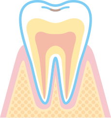 初期虫歯（CO）のイラスト