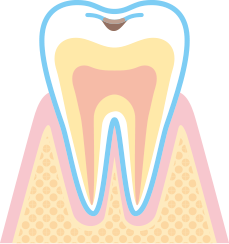 浅い虫歯（C1）のイラスト
