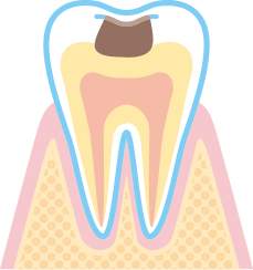 深い虫歯（C2）のイラスト