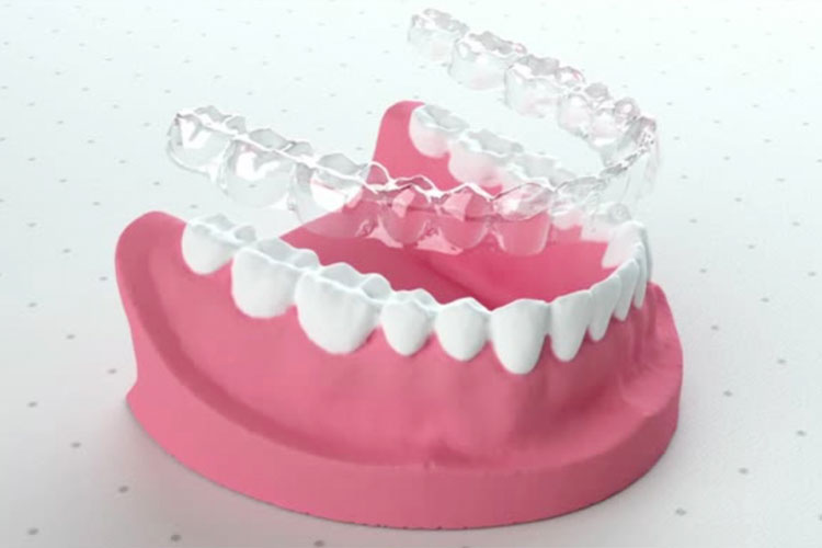 マウスピースの作成方法